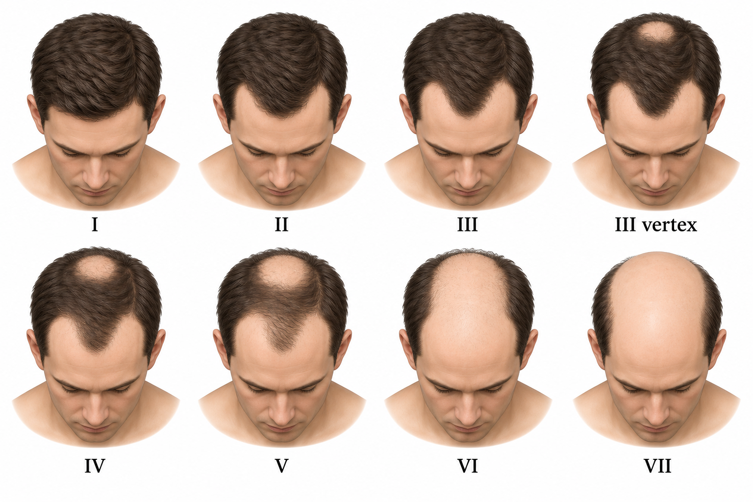 Иллюстрация степеней Норвуда: I, II, III, III vertex, IV, V, VI, VII